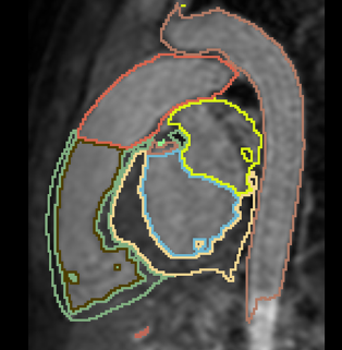 Example multi-chamber segmentation