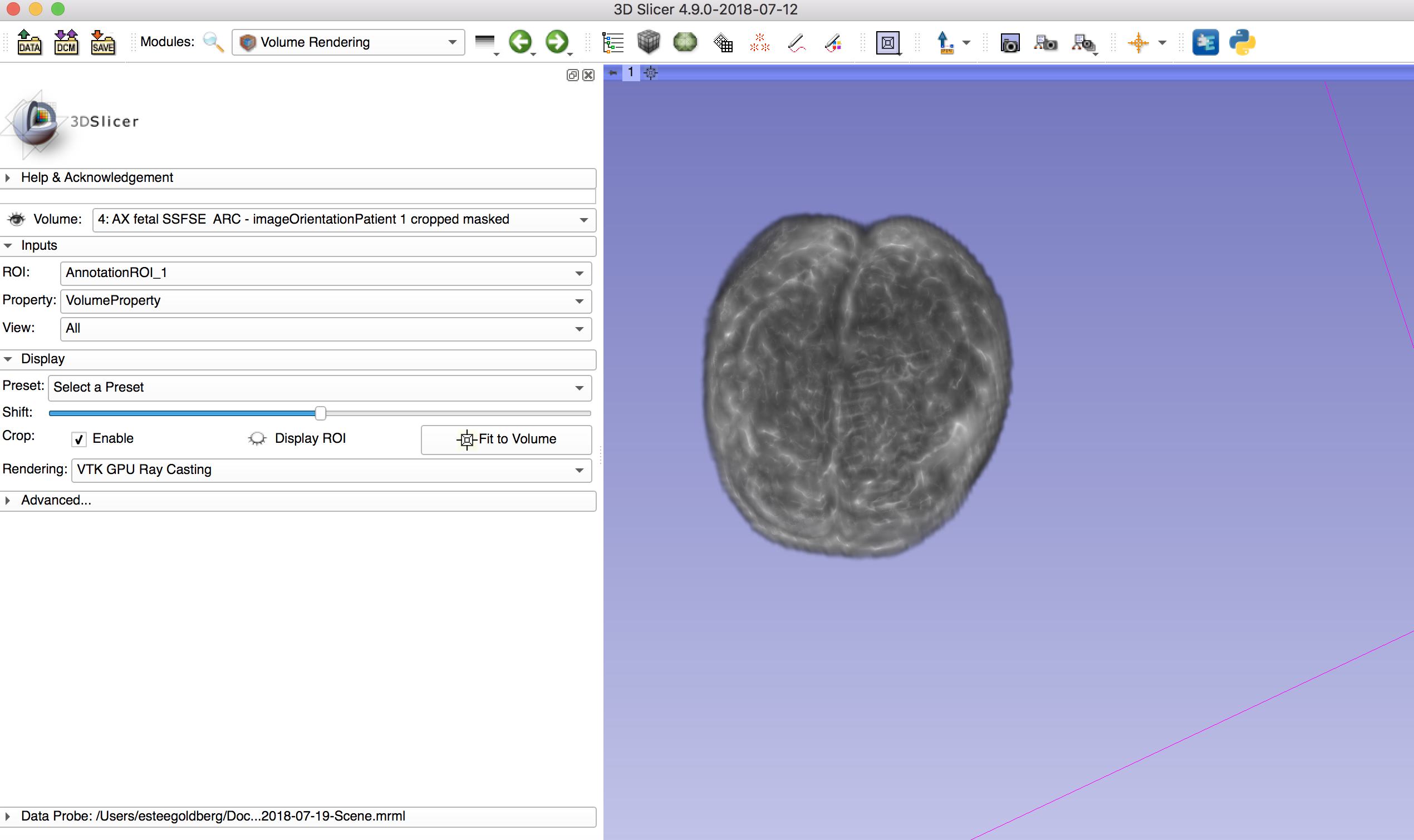 Segmented Baby Brain